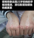 疫情期間，22歲醫護人員胡佩的手被消毒水和滑石粉浸泡侵蝕的傷痕累累